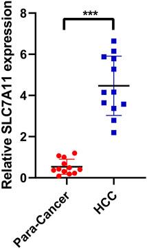Transcriptome Analysis of Solute Carrier-Associated Genes in Hepatocellular Carcinoma: Friend or Foe?